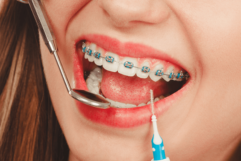 A woman with braces is brushing her teeth in a bathroom, focusing on her oral hygiene routine.