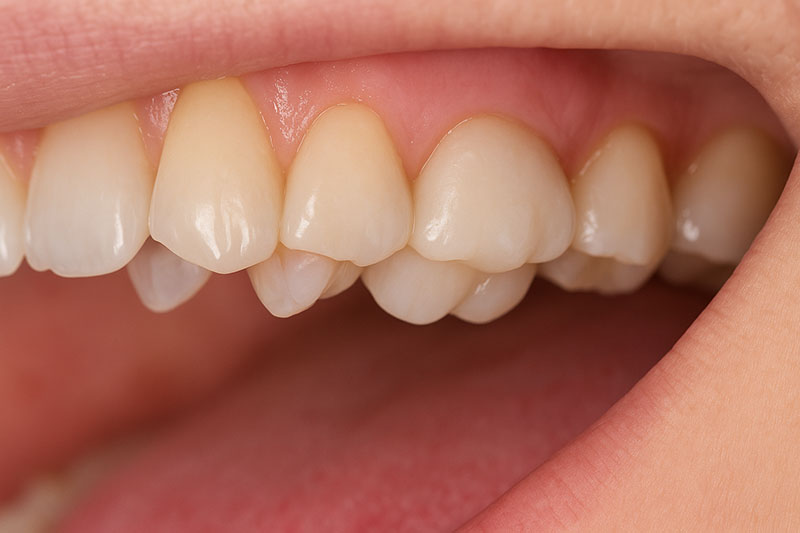 Dental Crowns: Restore Strength and Beauty to Your Smile
