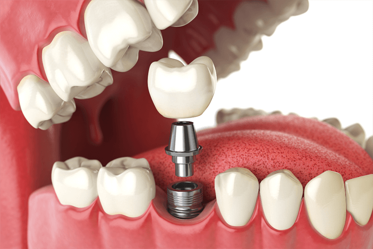 Illustration of a dental implant procedure, showing a crown being placed on an abutment and implant inside a human mouth.