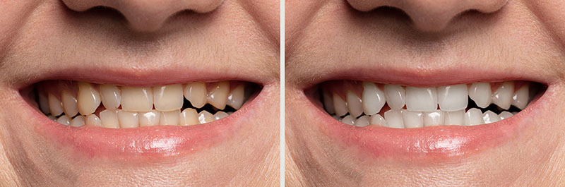 Before-and-after image showing cleaner, whiter teeth after professional dental cleaning.