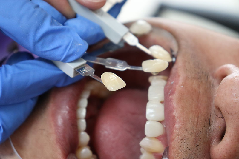 Dentist placing a permanent dental crown on a prepared tooth during the final fitting.